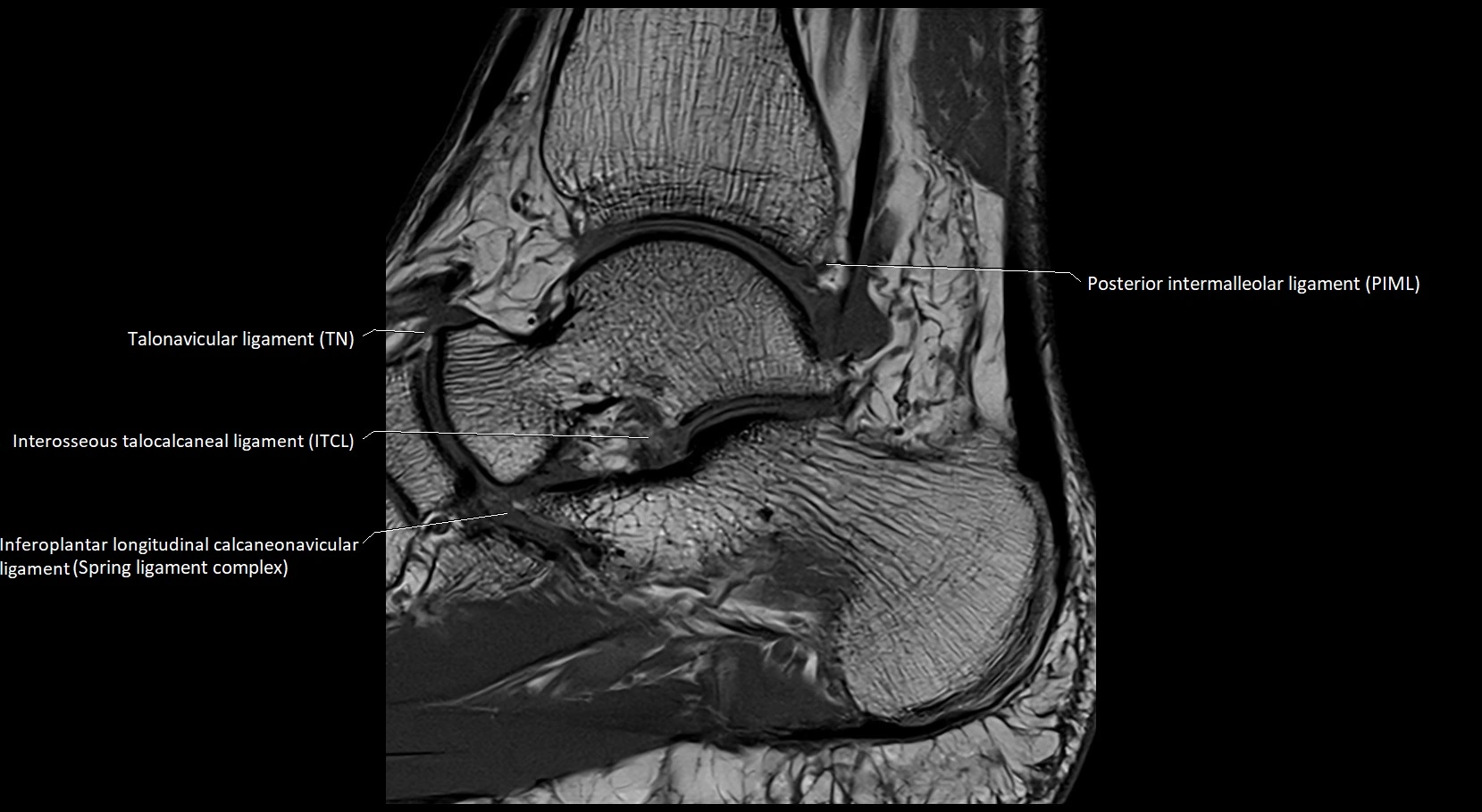 MRI ankle ligaments anatomy sagittal 3T image 13.webp